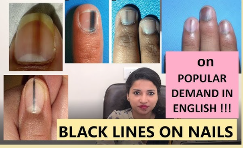 black line on nail