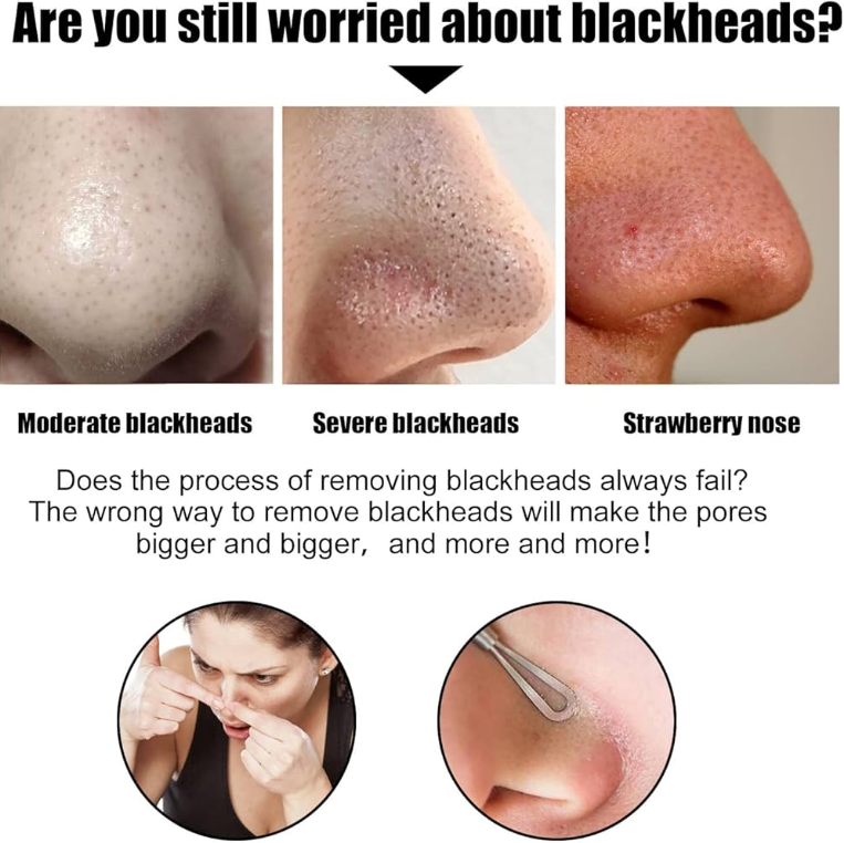 blackheads on nose