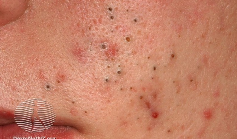 bumps on skin