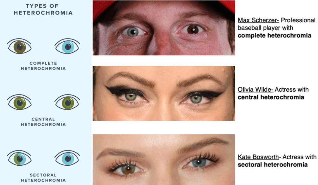 central heterochromia