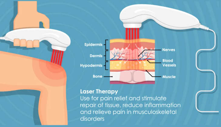 cold laser therapy