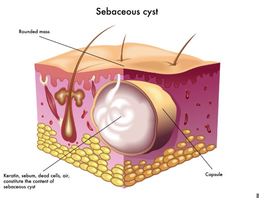 cyst