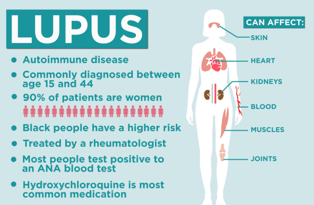 dying stages of lupus