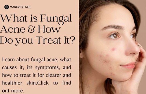 fungal acne