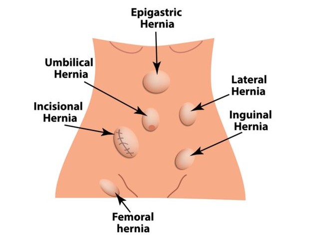 hernia