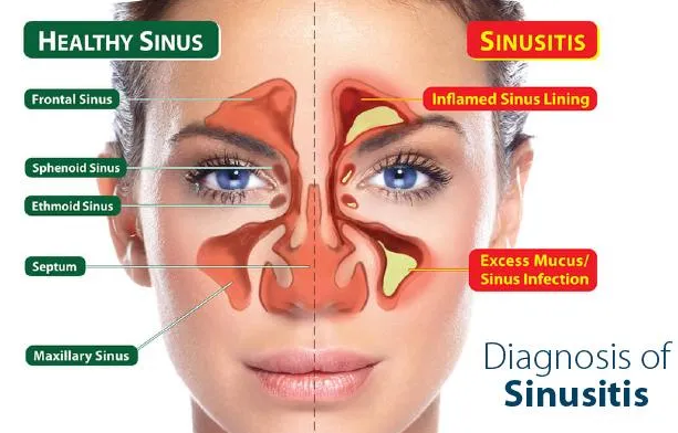 how to cure sinus permanently