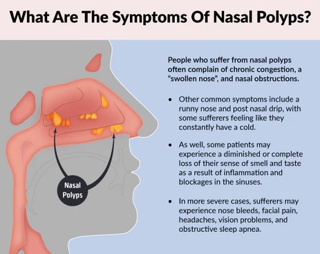 how to remove nasal polyps yourself