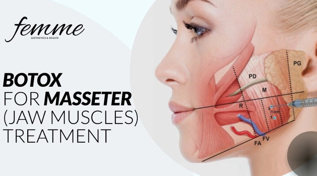 masseter botox