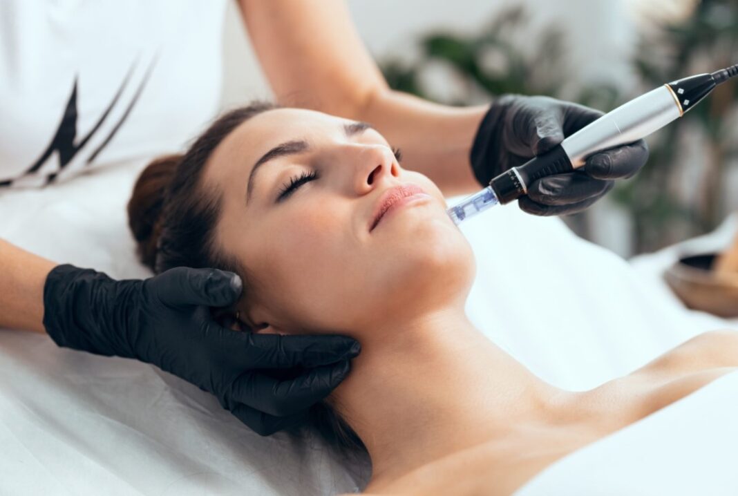 microneedling