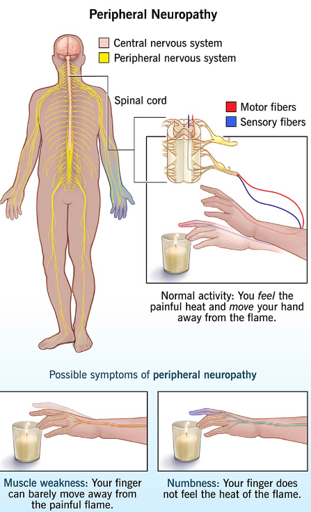 neuropathy