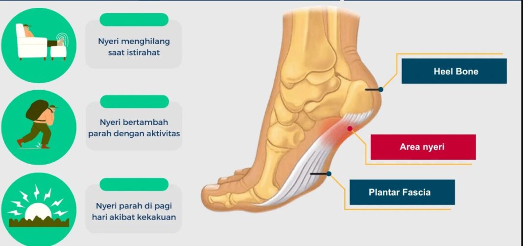 plantar fasciitis