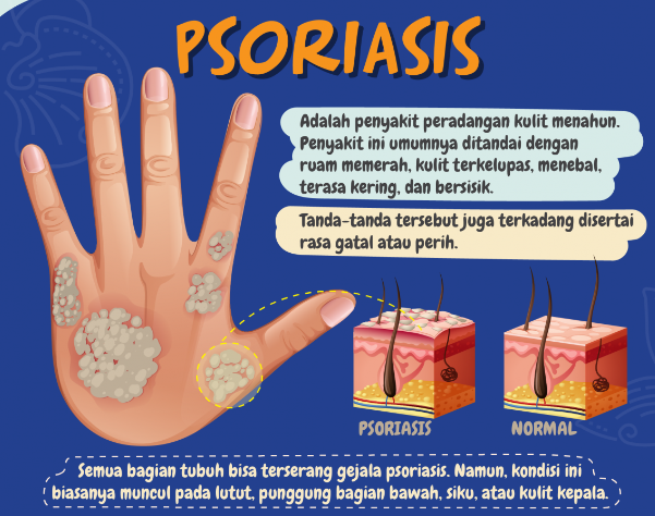 psoriasis