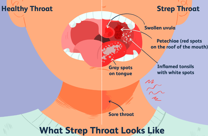 sore throat