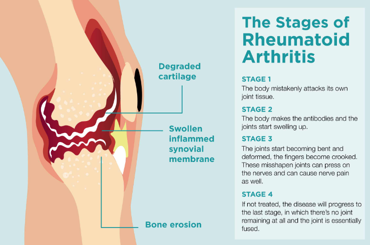 what are the 4 stages of rheumatoid arthritis