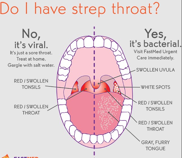 white spots on tonsils