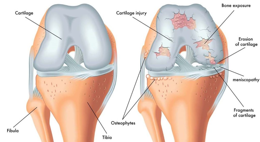 osteoarthritis